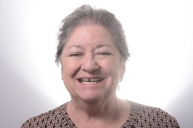 Our Results ALL ON 4 CASE WHIT SAME DAY TEETH INTERIM ARCHES - Before