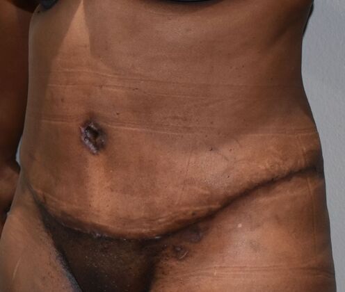 Tummy Tuck (Abdominoplasty): Case 491 - After