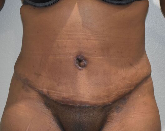 Tummy Tuck (Abdominoplasty): Case 491 - After
