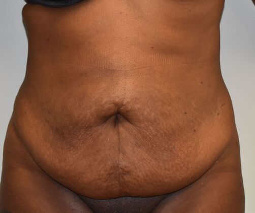 Tummy Tuck (Abdominoplasty): Case 491 - Before