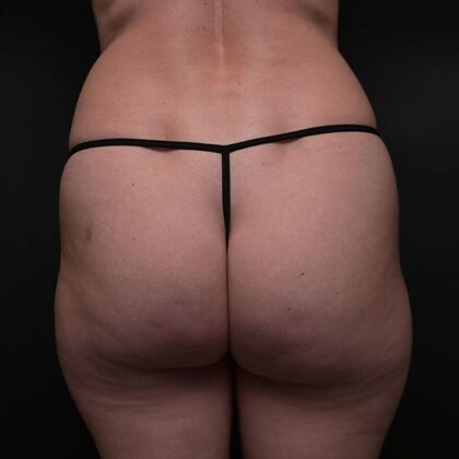 Brazilian Butt Lift Case 1 - Before