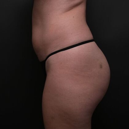 Brazilian Butt Lift: Case 1 - Before