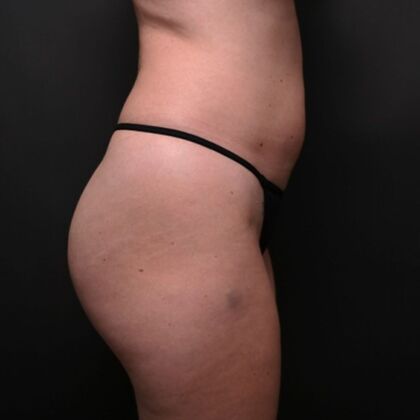 Brazilian Butt Lift: Case 1 - Before