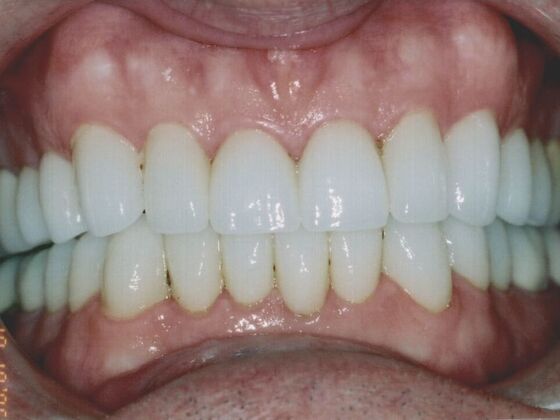 Full Mouth Rehabilitation Case 2 - After