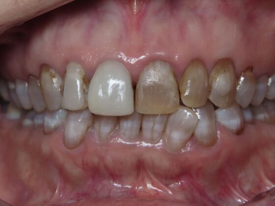 Crowns Case 2 - Before