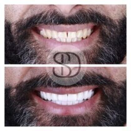 Full Mouth Restoration with Zirconia Crowns Case 4 - After
