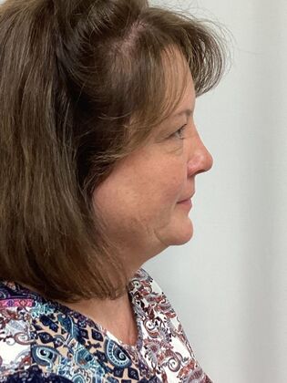 Facial Eyelid Surgery / Blepharoplasty: Case 14 (5086182) - Before