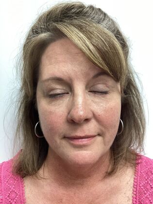 Facial Eyelid Surgery / Blepharoplasty: Case 14 (5086182) - After