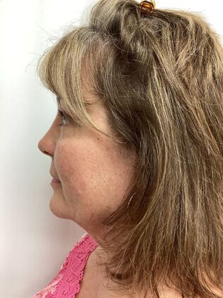 Facial Eyelid Surgery / Blepharoplasty: Case 14 (5086182) - Before