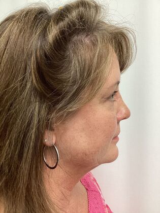 Facial Eyelid Surgery / Blepharoplasty: Case 14 (5086182) - After