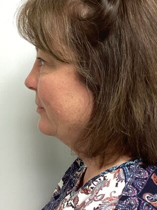 Facial Eyelid Surgery / Blepharoplasty: Case 14 (5086182) - After