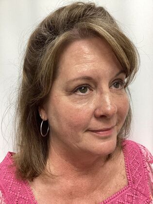 Facial Eyelid Surgery / Blepharoplasty: Case 14 (5086182) - After