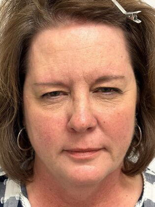 Facial Eyelid Surgery / Blepharoplasty: Case 14 (5086182) - Before