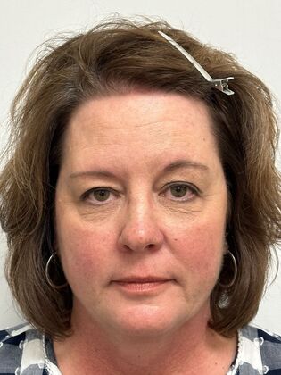 Facial Eyelid Surgery / Blepharoplasty Case 14 (5086182) - Before