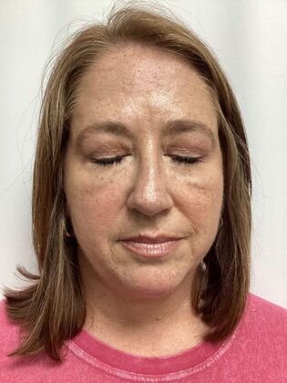 Facial Eyelid Surgery / Blepharoplasty: Case 15 (3271890) - After