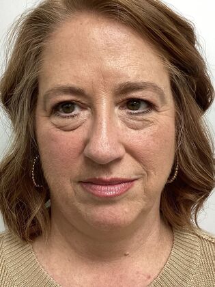 Facial Eyelid Surgery / Blepharoplasty Case 15 (3271890) - Before