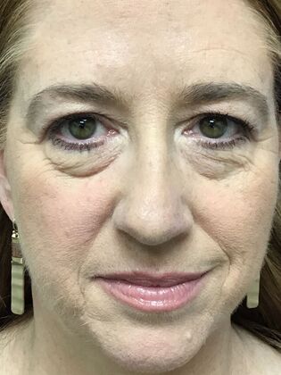 Facial Eyelid Surgery / Blepharoplasty: Case 15 (3271890) - Before