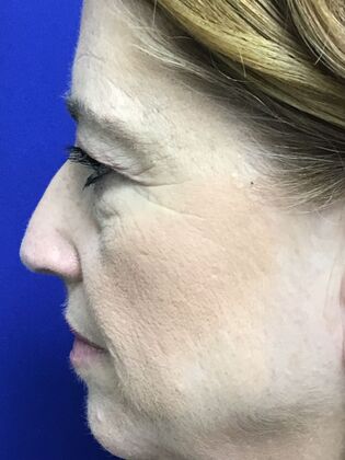 Facial Eyelid Surgery / Blepharoplasty: Case 15 (3271890) - Before