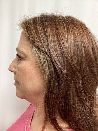 Facial Eyelid Surgery / Blepharoplasty: Case 15 (3271890) - After