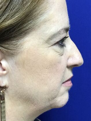 Facial Eyelid Surgery / Blepharoplasty: Case 15 (3271890) - Before