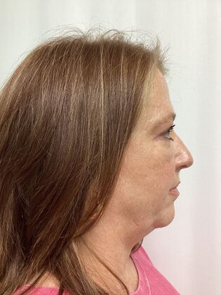 Facial Eyelid Surgery / Blepharoplasty: Case 15 (3271890) - After