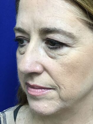 Facial Eyelid Surgery / Blepharoplasty: Case 15 (3271890) - Before
