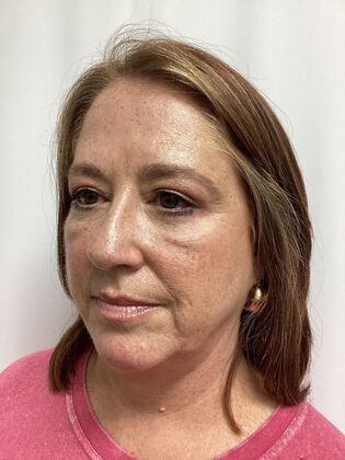 Facial Eyelid Surgery / Blepharoplasty: Case 15 (3271890) - After