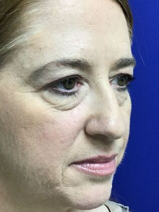 Facial Eyelid Surgery / Blepharoplasty: Case 15 (3271890) - Before