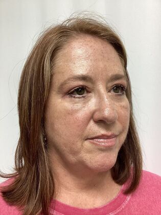 Facial Eyelid Surgery / Blepharoplasty: Case 15 (3271890) - After