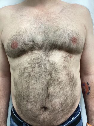 Male Breast / Gynecomastia: Case 9 (4911608) - Before