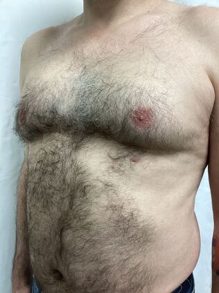 Male Breast / Gynecomastia: Case 9 (4911608) - Before