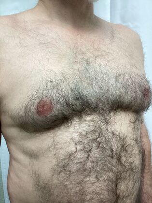 Male Breast / Gynecomastia: Case 9 (4911608) - Before