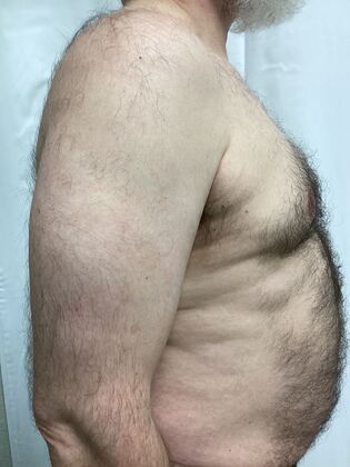 Male Breast / Gynecomastia: Case 9 (4911608) - Before