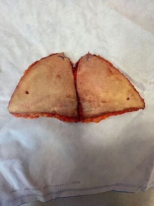 Body Mommy Make-Over: Case 12 (3158096) - Lower abd skin & fat, removed as two halves