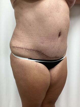 Body Mommy Make-Over: Case 12 (3158096) - After