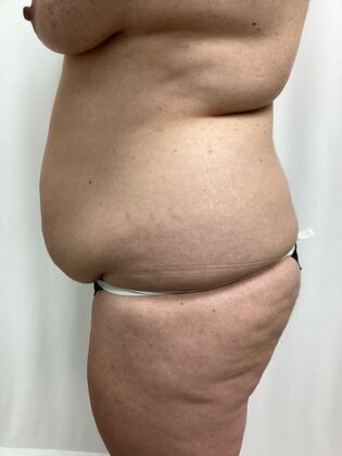 Body Mommy Make-Over: Case 12 (3158096) - Before