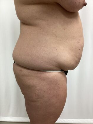 Body Mommy Make-Over: Case 12 (3158096) - Before