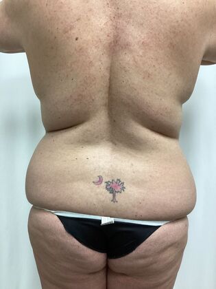 Body Mommy Make-Over: Case 12 (3158096) - Before liposuction, back view