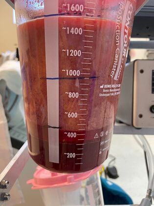 Body Mommy Make-Over: Case 12 (3158096) - Fat removed, with fluid layer at the bottom