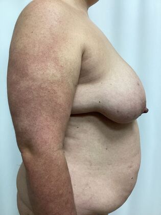 Body Mommy Make-Over: Case 12 (3158096) - Before