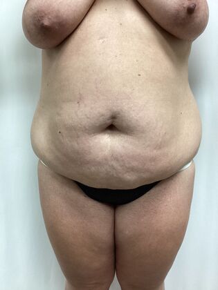 Body Tummy Tuck / Abdominoplasty Case 26 (3158096) - Before