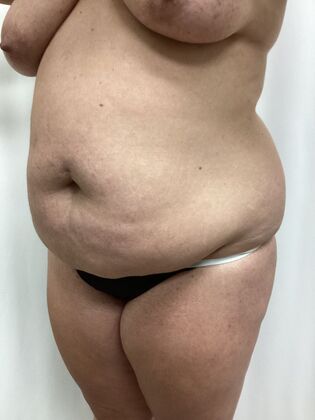 Body Tummy Tuck / Abdominoplasty: Case 26 (3158096) - Before
