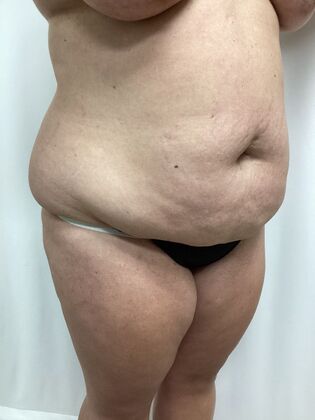 Body Tummy Tuck / Abdominoplasty: Case 26 (3158096) - Before