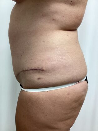 Body Tummy Tuck / Abdominoplasty: Case 26 (3158096) - After