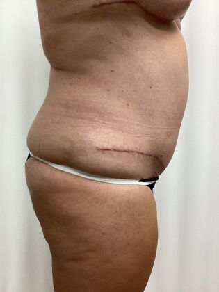 Body Tummy Tuck / Abdominoplasty: Case 26 (3158096) - After