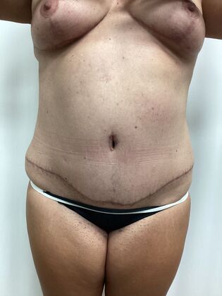 Breast Reduction: Case 35 (3158096) - After