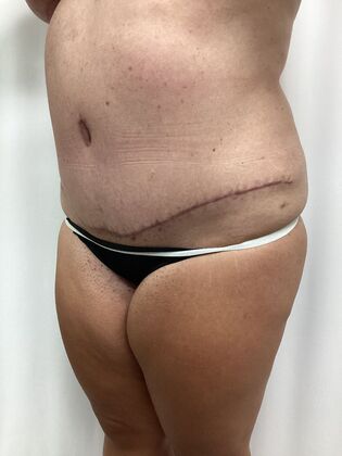 Breast Reduction: Case 35 (3158096) - After