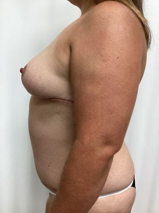 Breast Reduction: Case 35 (3158096) - After