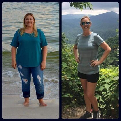 Gastric Sleeve - Click Here to See More! : Case 1 - Before & After