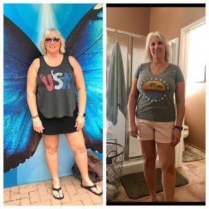 Gastric Sleeve - Click Here to See More! : Case 2 - Before & After